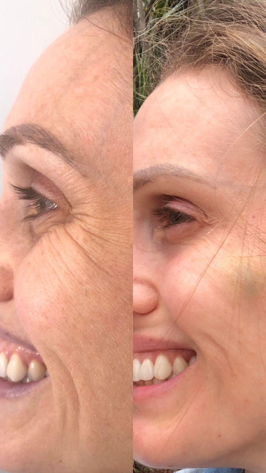 Harmonização Orofacial